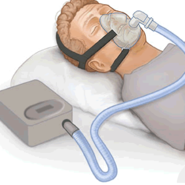 CPAP